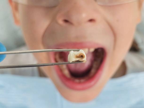 Best Broken or Cracked Tooth Emergency Dentist in Upland, PA